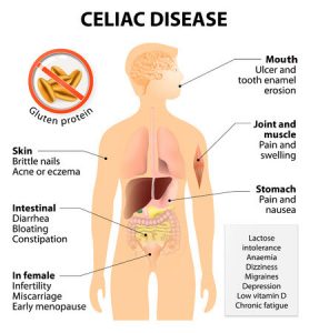 ibs symptoms celia disease