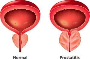 prostatitis visual